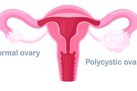 Managing PCOS with Regular Follow-Up