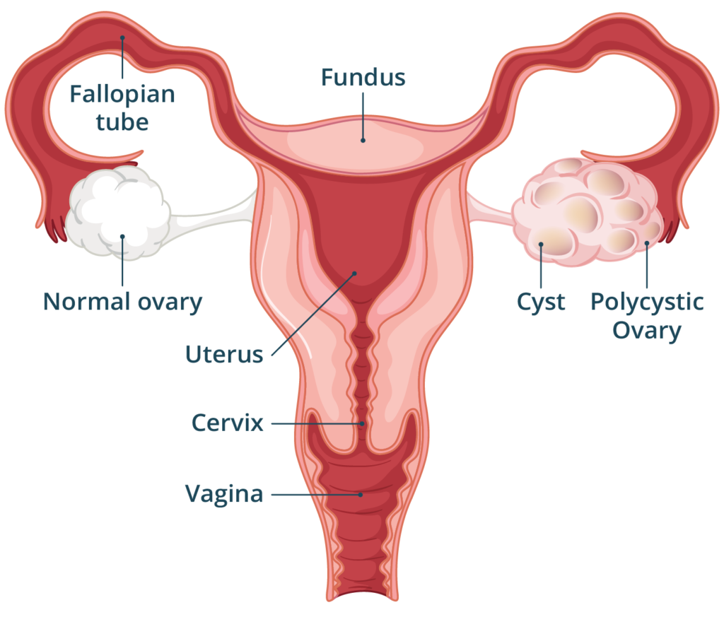 PCOS Natural Treatment