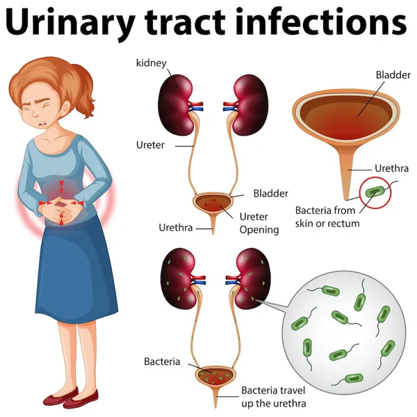 Female Urine Infection Treatments