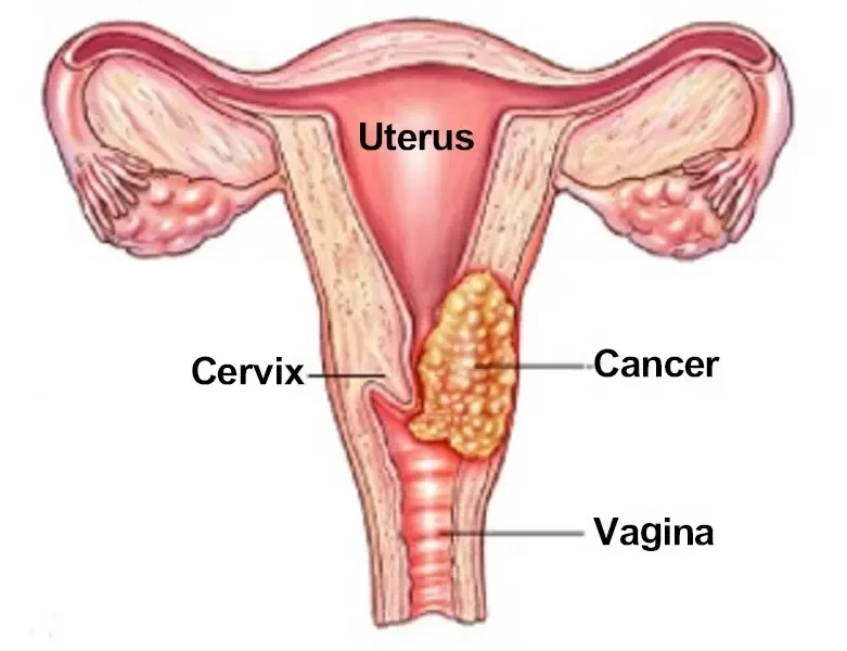 How Does Uterine Cancer Start? 1 Genesis of Uterine Tumors