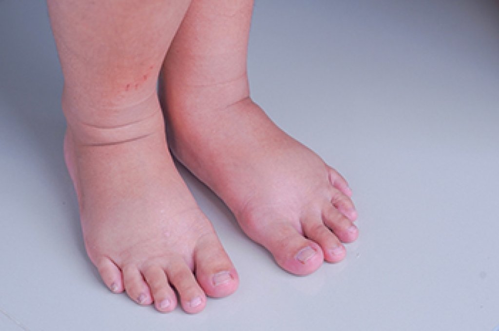 How to reduce swelling in feet during pregnancy? 3 Pregnancy Foot Swelling