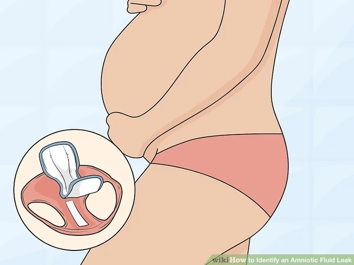 What Happens if a Pregnant Lady Gets a Fluid Leak? 2 Good Pregnancy Care in Vizag